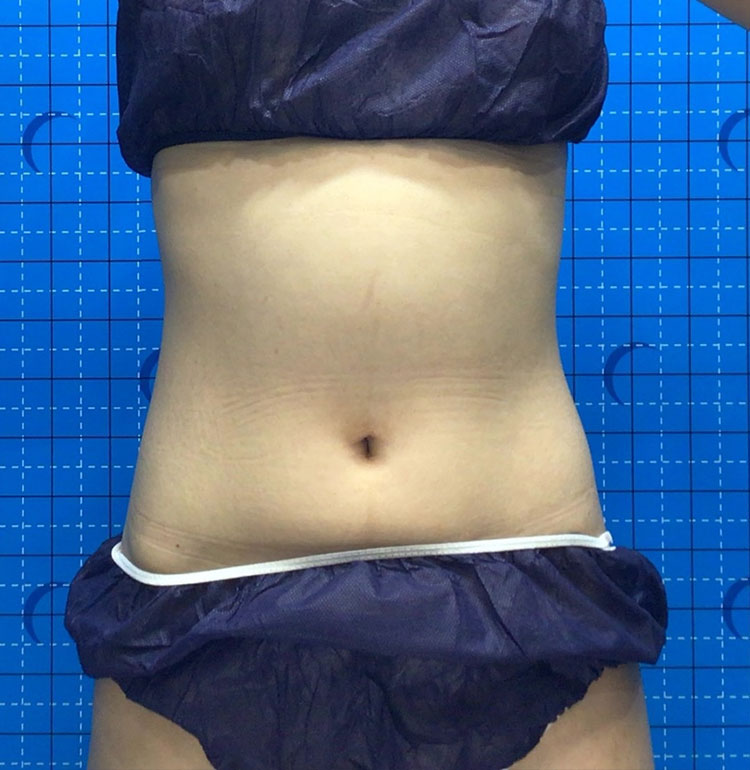 女性After