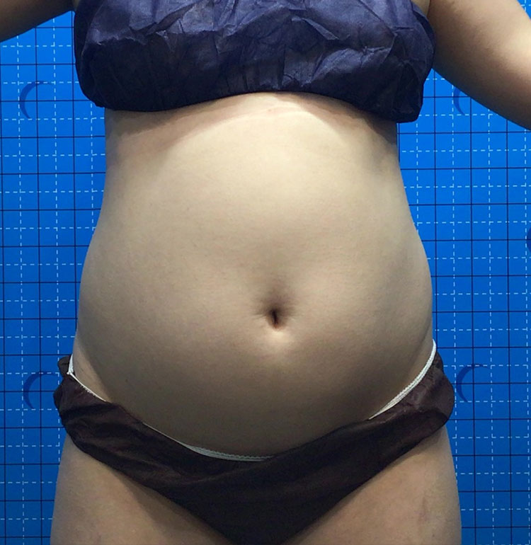 女性Before