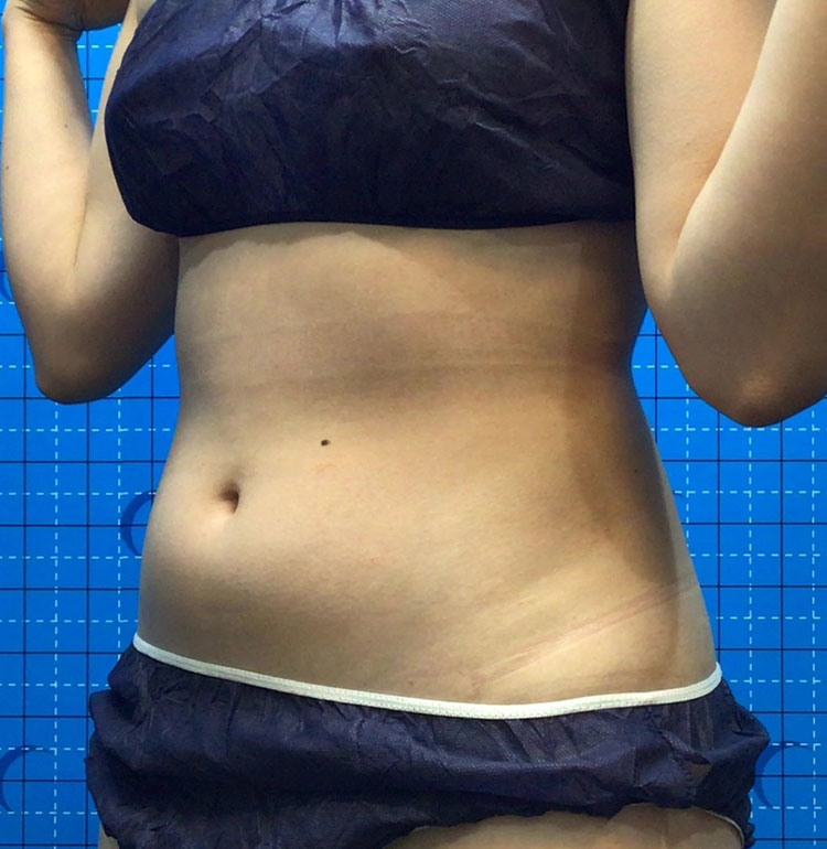 女性Before