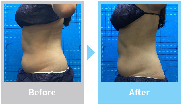 マンジャロ症例写真