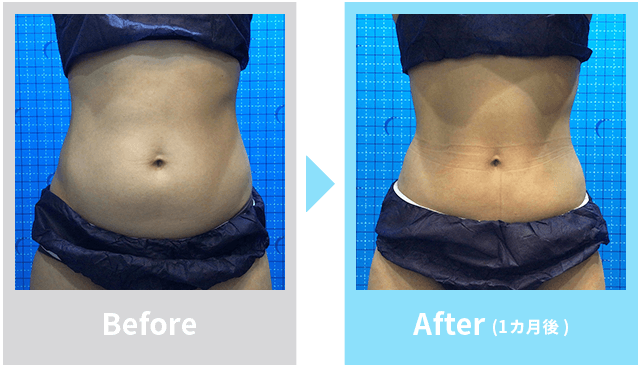 スキンボトックス症例写真2